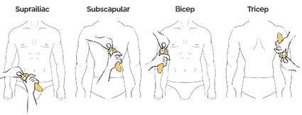 Skinfold measurement sites: Suprailiac, Subscapular, Bicep, and Tricep
